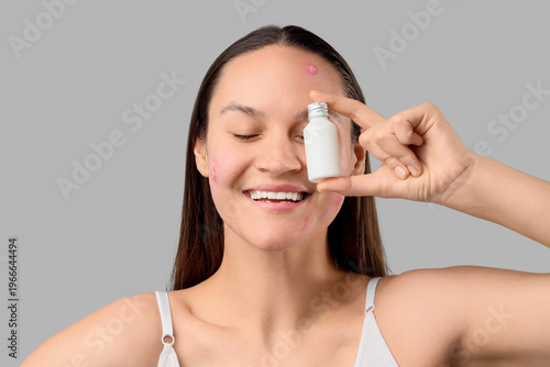 Happy young woman with acne...