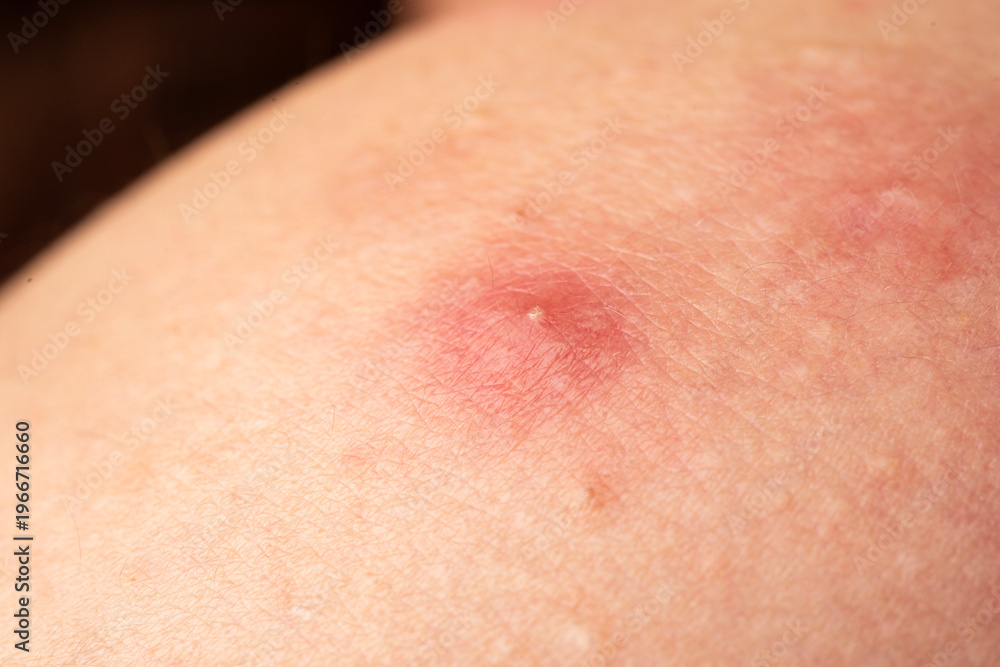 Fototapeta premium Acne skin pimple. Skin problem with inflamed bumps. Irritated skin texture. Close up skin issue.