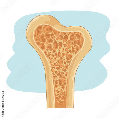 Osteoporosis Bone Density Loss Anatomy Illustration