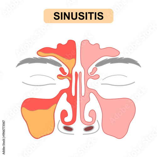 Sinusitis Medical Illustration Showing Healthy vs Inflamed Paranasal Sinuses with Frontal, Ethmoid, and Maxillary Sinus Anatomy, Mucus Buildup. Vector for poster, science and education.