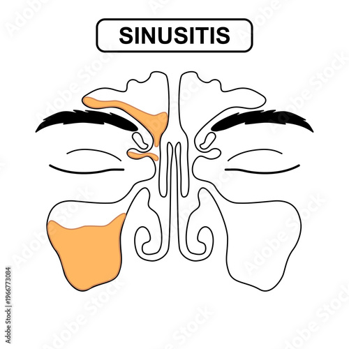Sinusitis Medical Illustration Showing Healthy vs Inflamed Paranasal Sinuses with Frontal, Ethmoid, and Maxillary Sinus Anatomy, Mucus Buildup. Vector line drawing for poster, science and education.	