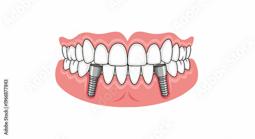 Dental implants shown in a cartoonish illustration of gums and teeth