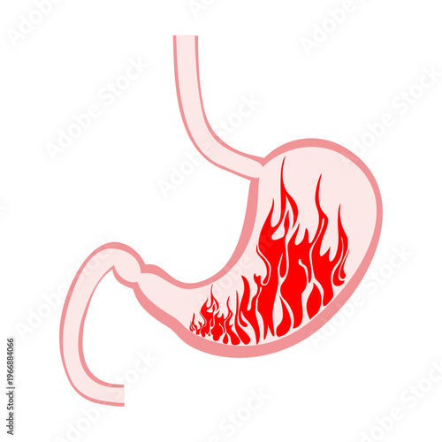 Stomach fire. Excessive acidity, indigestion, stomach disease, gastric ulcer, severe abdominal pain.  Sign of stomach with heartburn. Vector illustration