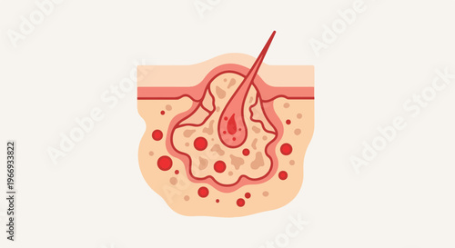 Diagram of a pore with a hair follicle and oil glands, showing inflammation