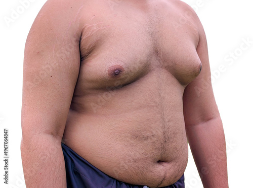 Fotografía Overweight man with gynecomastia and excess belly fat, male chest with enlarged