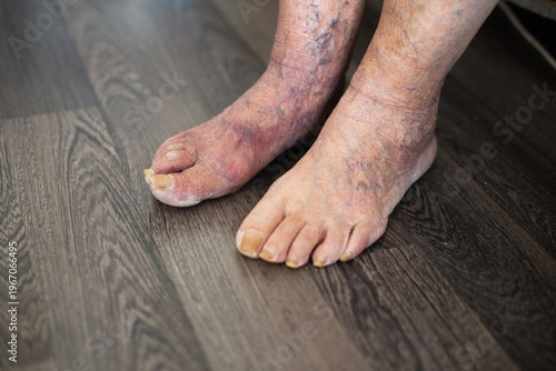 Elderly feet showing varicose veins and skin discoloration with fungus