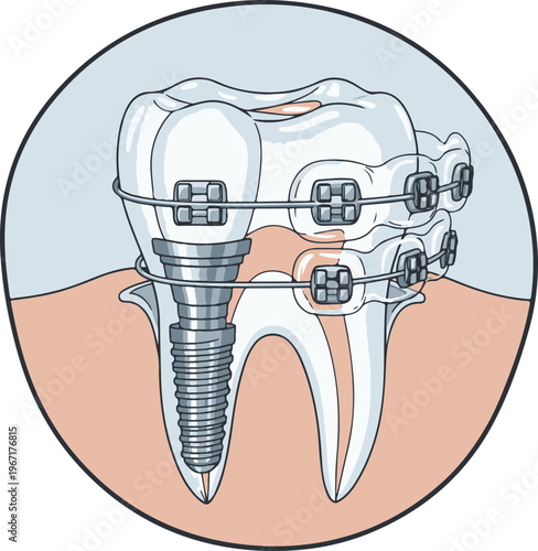 Anatomical Dental Implant and Braces Illustration - Cross Section of Tooth Orthodontic Treatment and Gingiva