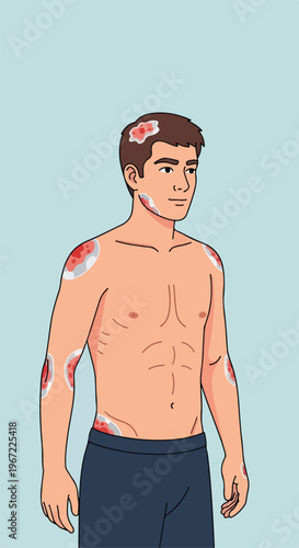 Illustration of a shirtless man showing visible red skin lesions on his body