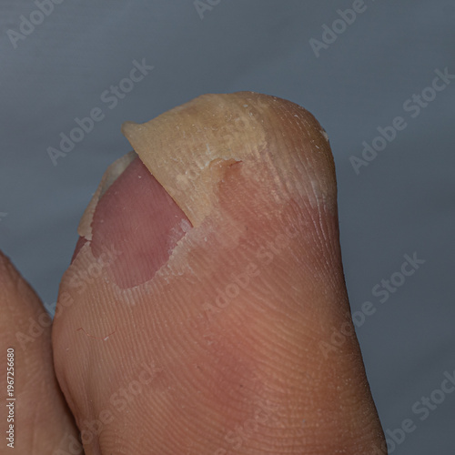 Close-up of damaged toenail with peeling skin, suitable for medical, dermatology, foot care, and health condition concepts highlighting skin issues and nail problems.