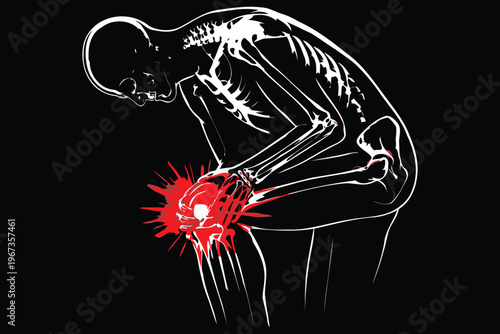 Human skeleton illustration depicting a severe elbow injury with blood explosion effect Vector