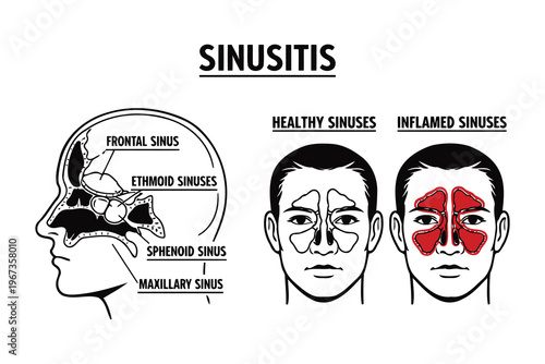 Comparison of healthy and inflamed sinuses in sinusitis condition Vector