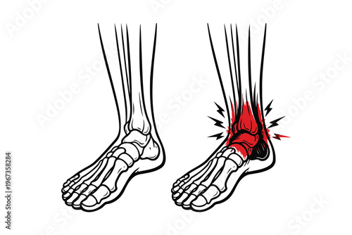 Illustration of a heel injury showing affected plantar fascia area in the foot Vector
