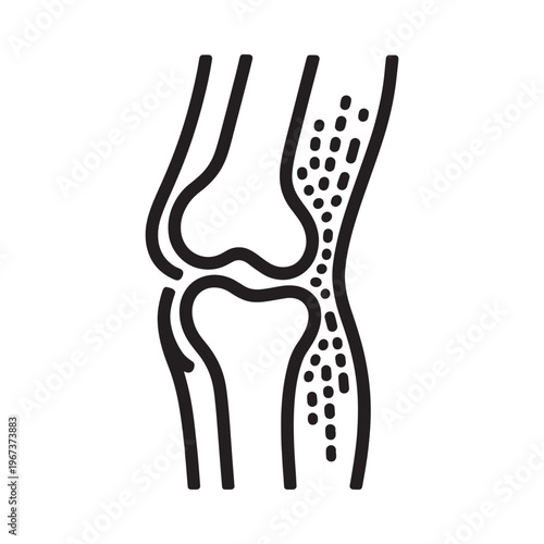 Simplified illustration of a human knee joint displaying signs of osteoarthritis
