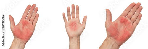 Photos Close-up of human palms with red skin rash, Palmar Erythema symptoms or allergic