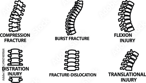 Spinal injuries and fractures illustrations including compression burst flexion distraction fracturedislocation translational