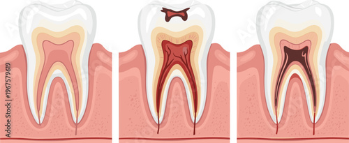 Set of Dental Tooth Decay Illustrations Showing Stages of Cavities for Oral Health, Dentistry, and Educational Themes