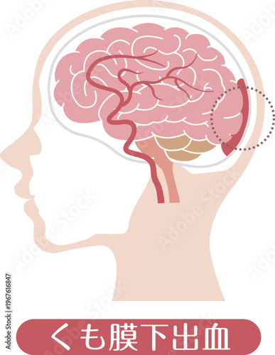 Subarachnoid hemorrhage medical illustration brain bleeding diagram	
