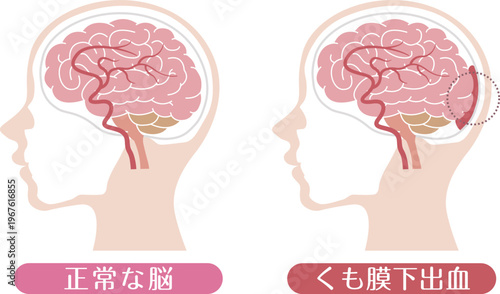 Subarachnoid hemorrhage comparison with normal brain medical illustration	