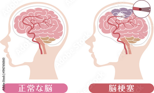 Ischemic stroke brain infarction comparison with normal brain medical illustration	