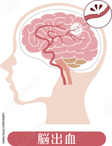 Cerebral hemorrhage medical illustration brain bleeding diagram	