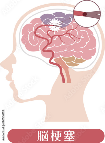 Ischemic stroke brain infarction medical illustration	
