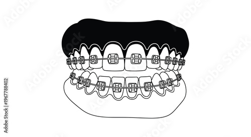 Black and white illustration of a mouth with dental braces