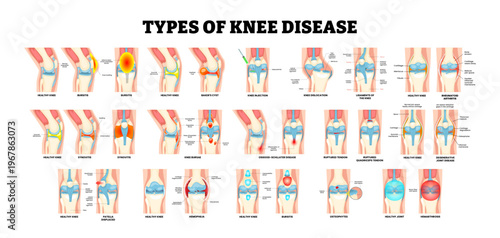 Different types of knee disease types poster design set collection. Knee injury. Labeled bursitis, bakers cyst, knee injection, knee dislocation rheumatoid arthritis synovitis bursae ruptured tendon