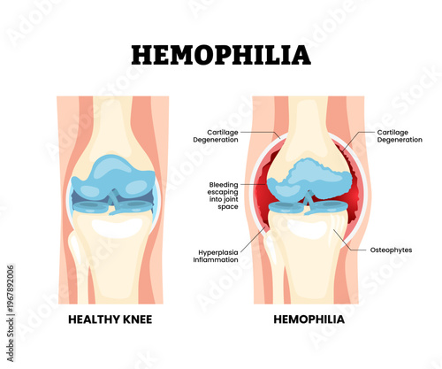 Hemophilia joint knee disease. Labeled cartilage degeneration, hyperplasia, osteophytes, bleeding joint space. Synovial joint anatomy. Frontal view of human knee joint. Vector illustration.