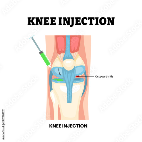 Knee injection joint knee disease. Labeled osteoarthritis cracked bone, injection, synovial fluid cartilage wear inflammation. Synovial joint anatomy Frontal view human knee joint Vector illustration.