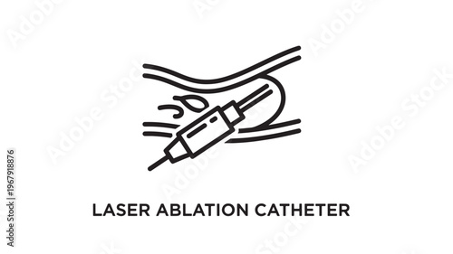 Black and white medical illustration of a laser ablation catheter used in cardiac vein care, ideal for healthcare education, research publications, and medical marketing materials.