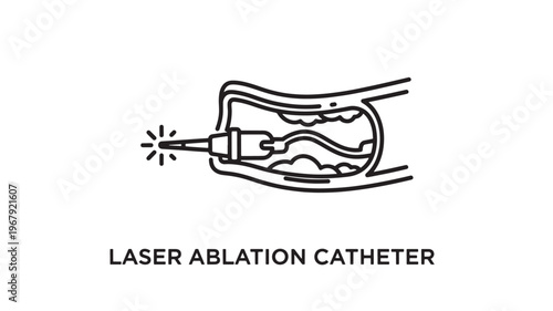 Medical illustration of a laser ablation catheter used for treating varicose veins with a minimally invasive procedure