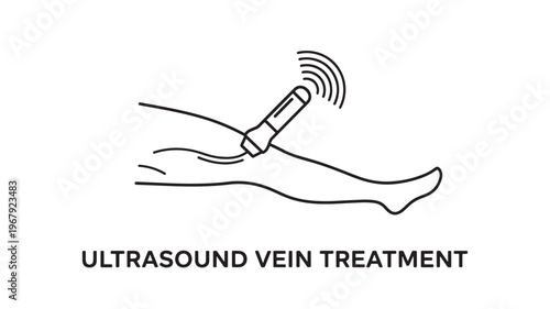 Illustration of ultrasound vein treatment being performed on a leg with a medical device, representing a modern medical procedure for vein care and health.