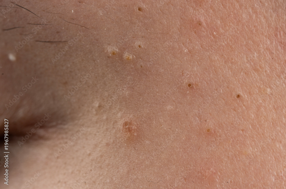 Fototapeta premium Pimple on epidermis with pustule and bumps. Acne with comedone and inflamed pores. Skincare for pimple and inflammation. Macro detail of acne with texture.