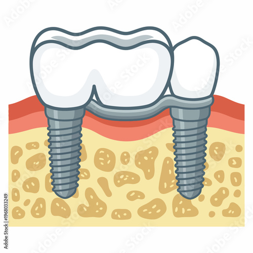 An informative illustration of a dental implant, showing detail in the structure, essential for dental education, clarity, and understanding complex concepts.