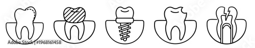 Dental treatment tooth set with restoration contour filling, dental crown cap, implant screw with crown, caries cavity damage and cracked fractured tooth root