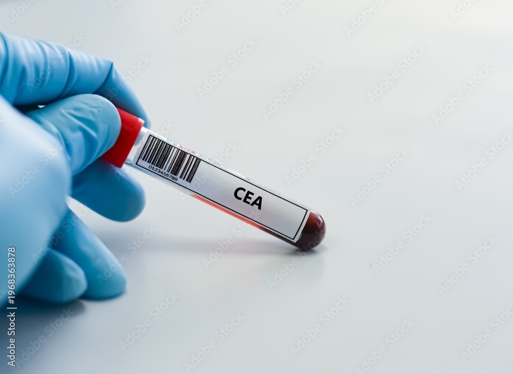 Obraz premium Blood sample tube for CEA test analysis.
