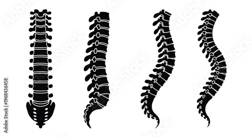 Four spinal column variations displayed in a stark black silhouette