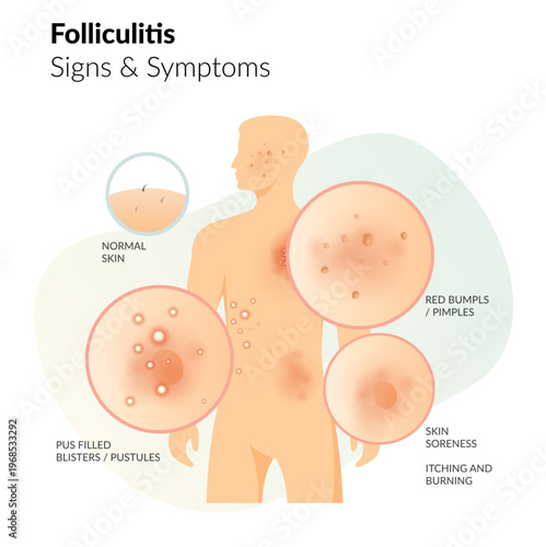 Folliculitis - Key causes & Symptoms - Stock Illustration