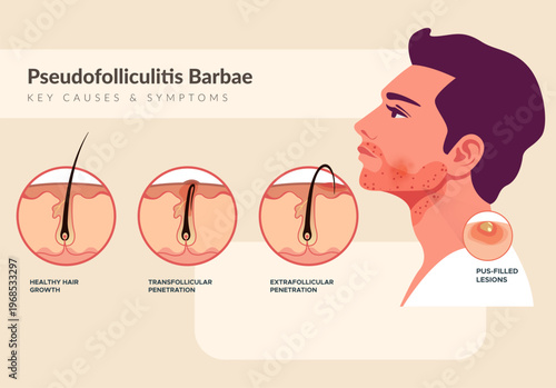 Pseudofolliculitis Barbae - Key causes & Symptoms - Stock Illustration