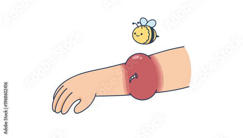 Swollen bee sting reaction flat vector illustration. Insect bite and skin inflammation concept. Medical graphic isolated on transparent background