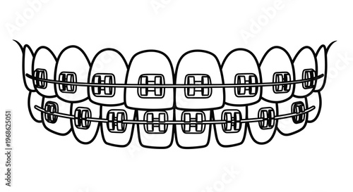 Line art illustration of teeth with silver orthodontic braces applied