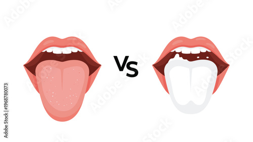 Comparison illustration showing a healthy pink tongue and an unhealthy white tongue indicating oral health problems or infection.