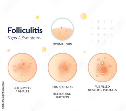 Folliculitis - Key causes & Symptoms - Stock Illustration