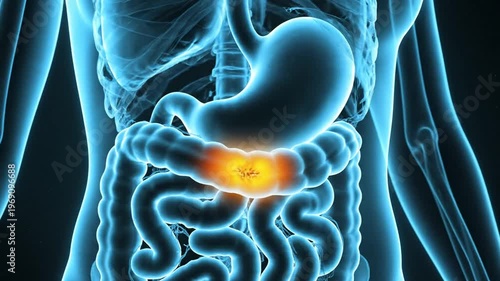 Human Anatomy Digestive System Animation X-Ray View of Colon Inflammation with Stomach and