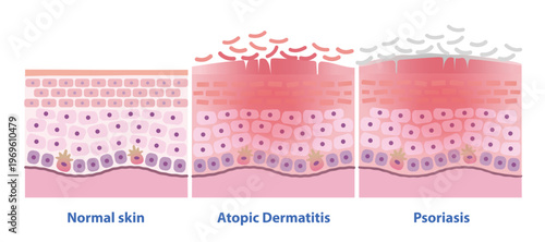 Comparison of normal skin, Atopic Dermatitis and Psoriasis vector illustration. Cross section of Eczema, itchy, red, inflamed, leading to dry, scaly. Psoriasis plaques are thick, silvery scales.
