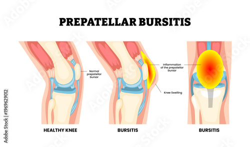 Prepatellar bursitis joint knee disease. Normal and inflamed prepatellar bursae, swollen knee swelling. Fluid accumulation, patellar tendon, subcutaneous tissue. Frontal side view Vector illustration.