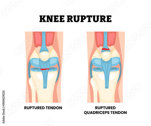 Knee extensor mechanism injury. Labeled ruptured quadriceps tendon, patellar tendon tear, and hematoma. Synovial joint anatomy. Frontal view of human knee joint. Vector illustration.