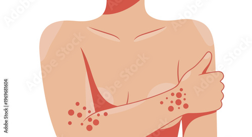 Illustration of a person with a skin rash on their arm.