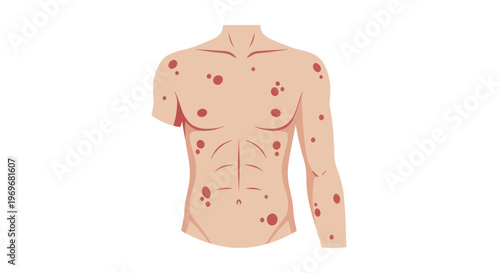 Human Torso with Skin Lesions and Rashes.