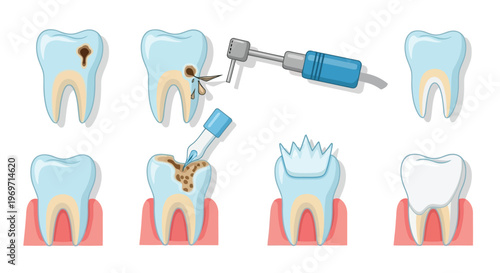 Dental cavity treatment and tooth filling procedure illustration